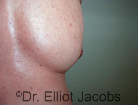 Male nipple, after Puffy Nipple treatment, oblique view - patient 46