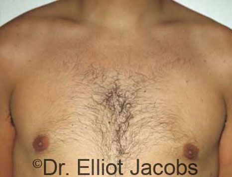 Male breast, after Gynecomastia treatment, front view, patient 10
