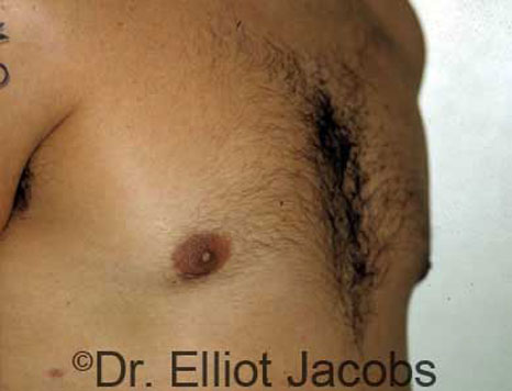 Male breast, after Gynecomastia treatment, r-side oblique view - patient 10