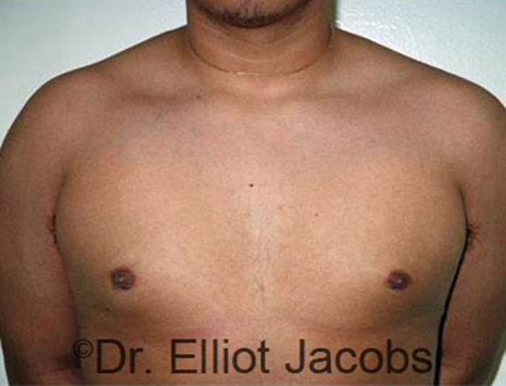 Men's breast, after Gynecomastia Adolescent treatment, front view - patient 21