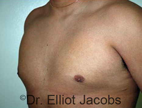 Men's breast, after Gynecomastia Adolescent treatment, oblique view - patient 21