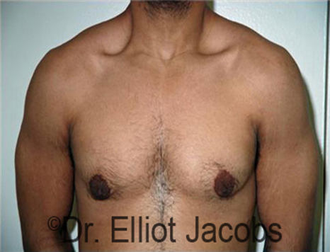 Men's breast, after Gynecomastia Adolescent treatment, front view - patient 22