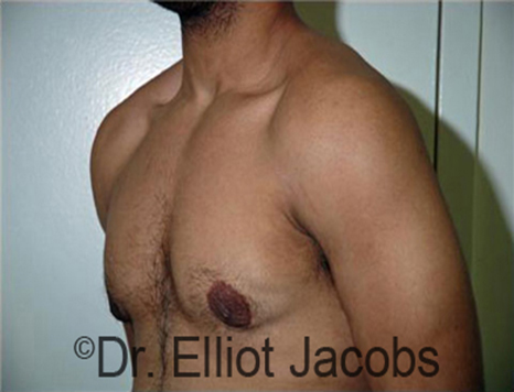Men's breast, after Gynecomastia Adolescent treatment, oblique view - patient 22