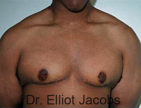 Men's breast, after Gynecomastia Adolescent treatment, front view - patient 23