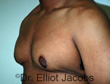 Men's breast, after Gynecomastia Adolescent treatment, oblique view - patient 23