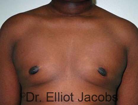 Men's breast, after Gynecomastia Adolescent treatment, front view - patient 24