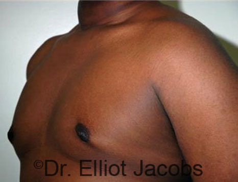 Men's breast, after Gynecomastia Adolescent treatment, oblique view - patient 24