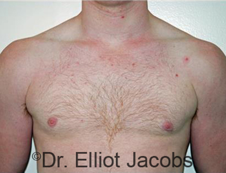 Men's breast, after Gynecomastia Adolescent treatment, front view - patient 25