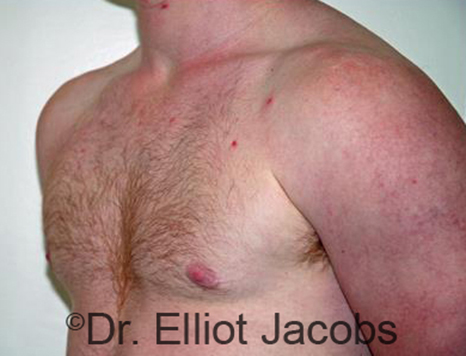 Men's breast, after Gynecomastia Adolescent treatment, oblique view - patient 25
