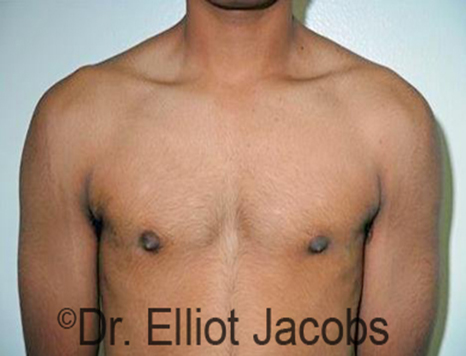 Men's breast, after Gynecomastia Adolescent treatment, front view - patient 26