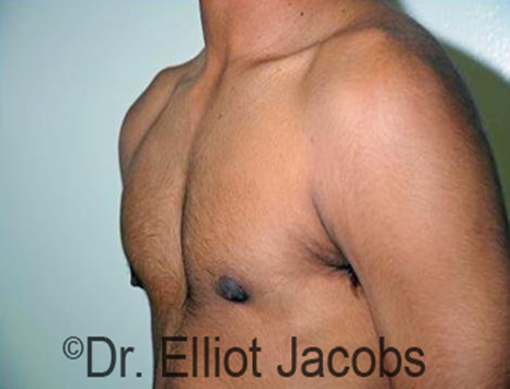 Men's breast, after Gynecomastia Adolescent treatment, oblique view - patient 26