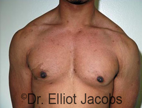 Men's breast, after Gynecomastia Adolescent treatment, front view - patient 27