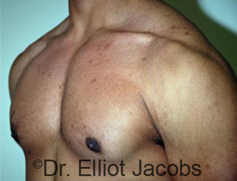 Men's breast, after Gynecomastia Adolescent treatment, oblique view - patient 27