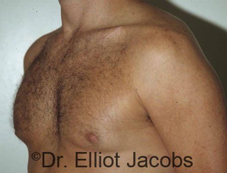 Men's breast, after Gynecomastia treatment in Bodybuilders, oblique view - patient 1