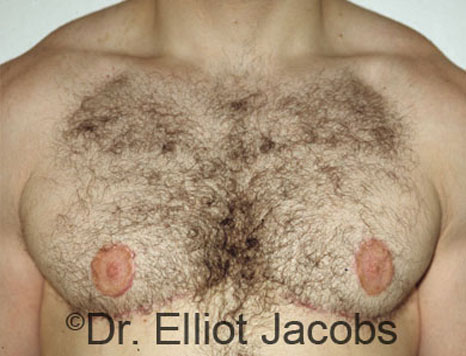 Male breast, after gynecomastia Adolescent treatment, front view, patient 1