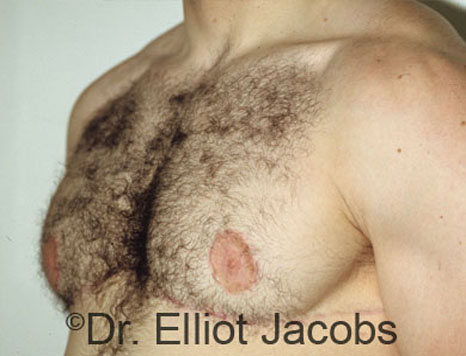 Men's breast, after Gynecomastia treatment in Bodybuilders, oblique view - patient 2