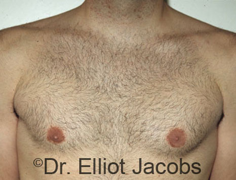 Men's breast, after Gynecomastia treatment in Bodybuilders, front view - patient 3