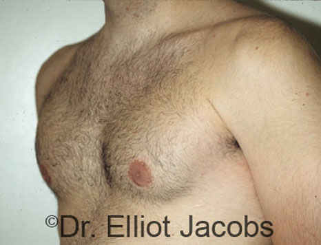Men's breast, after Gynecomastia treatment in Bodybuilders, oblique view - patient 3
