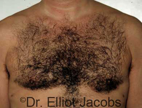 Male breast, after Gynecomastia treatment, front view, patient 11