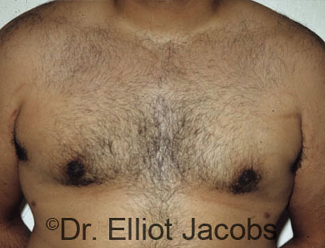 Men's breast, after Gynecomastia treatment in Bodybuilders, front view - patient 4
