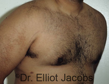 Men's breast, after Gynecomastia treatment in Bodybuilders, oblique view - patient 4