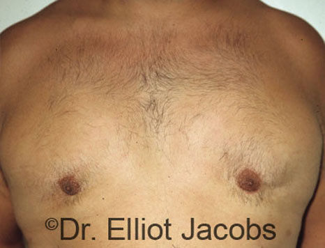 Men's breast, after Gynecomastia treatment in Bodybuilders, front view - patient 5