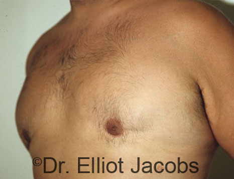 Men's breast, after Gynecomastia treatment in Bodybuilders, oblique view - patient 5
