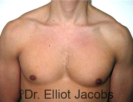 Men's breast, after Gynecomastia treatment in Bodybuilders, front view - patient 6