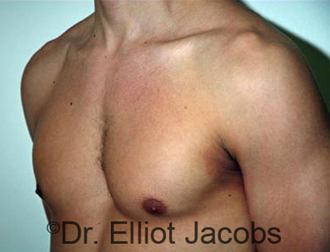 Men's breast, after Gynecomastia treatment in Bodybuilders, oblique view - patient 6