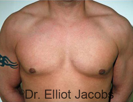 Men's breast, after Gynecomastia treatment in Bodybuilders, front view - patient 7