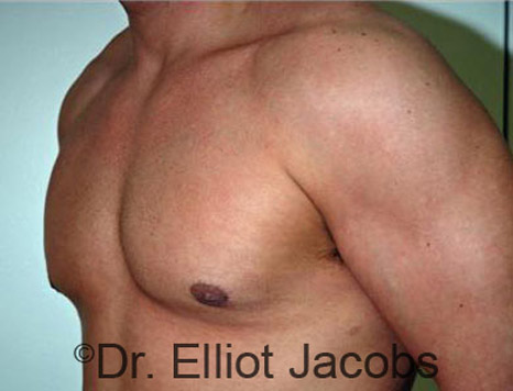 Men's breast, after Gynecomastia treatment in Bodybuilders, oblique view - patient 7