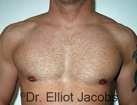 Men's breast, after Gynecomastia treatment in Bodybuilders, front view - patient 8