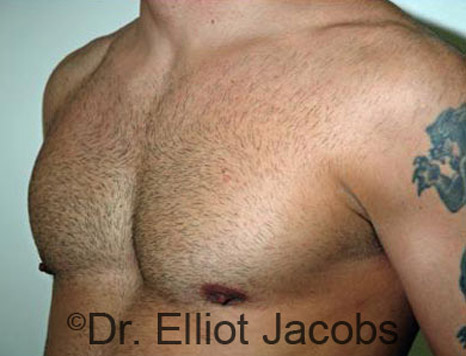 Men's breast, after Gynecomastia treatment in Bodybuilders, oblique view - patient 8