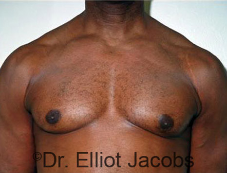 Men's breast, after Gynecomastia treatment in Bodybuilders, front view - patient 9