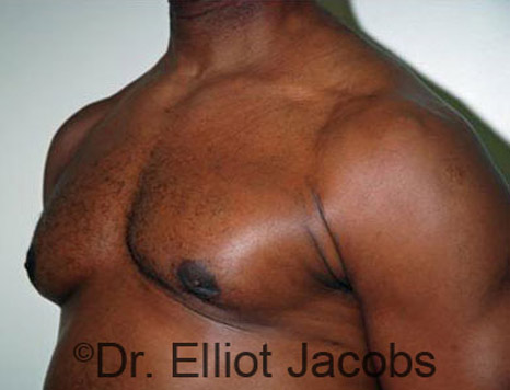 Men's breast, after Gynecomastia treatment in Bodybuilders, oblique view - patient 9