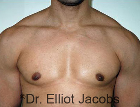 Men's breast, after Gynecomastia treatment in Bodybuilders, front view - patient 10