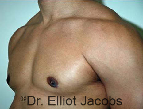 Men's breast, after Gynecomastia treatment in Bodybuilders, oblique view - patient 10