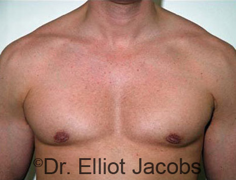 Men's breast, after Gynecomastia treatment in Bodybuilders, front view - patient 11