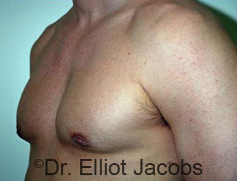 Men's breast, after Gynecomastia treatment in Bodybuilders, oblique view - patient 11