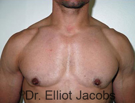 Men's breast, after Gynecomastia treatment in Bodybuilders, front view - patient 12