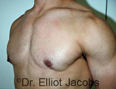 Men's breast, after Gynecomastia treatment in Bodybuilders, oblique view - patient 12