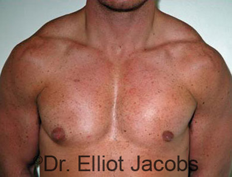 Men's breast, after Gynecomastia treatment in Bodybuilders, front view - patient 13