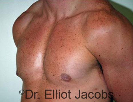 Men's breast, after Gynecomastia treatment in Bodybuilders, oblique view - patient 13