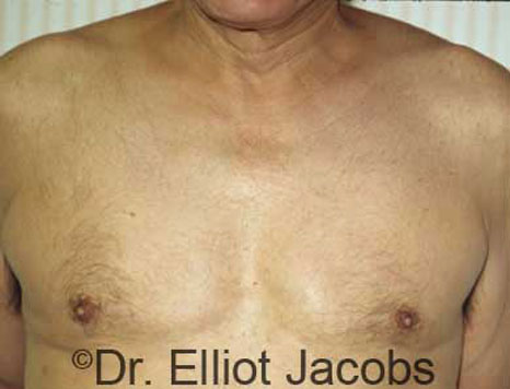 Male breast, after Gynecomastia treatment, front view, patient 12