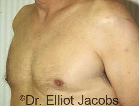 Male breast, after Gynecomastia treatment, l-side oblique view - patient 12