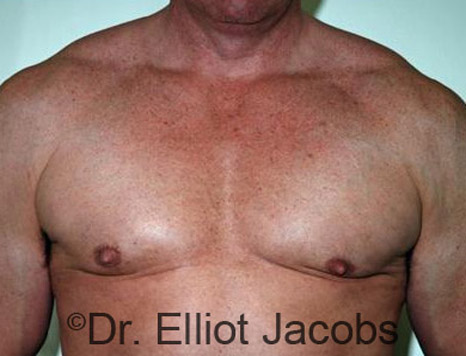 Men's breast, after Gynecomastia treatment in Bodybuilders, front view - patient 14