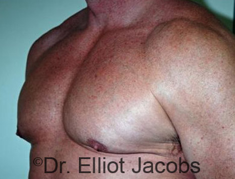 Men's breast, after Gynecomastia treatment in Bodybuilders, oblique view - patient 14
