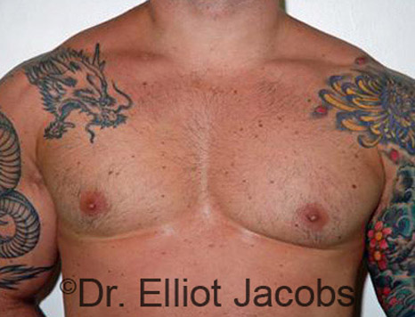 Men's breast, after Gynecomastia treatment in Bodybuilders, front view - patient 15