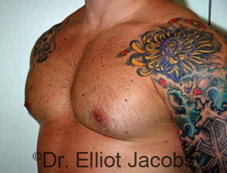 Men's breast, after Gynecomastia treatment in Bodybuilders, oblique view - patient 15