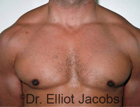 Men's breast, after Gynecomastia treatment in Bodybuilders, front view - patient 16